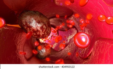 Tumour Cells In Blood Vessels 3d Illustration 