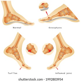 Turf Toe Injuries. Inflamed Joint. Runners Foot Injuries. Stiff Big Toe. Sesamoid Injuries In The Foot