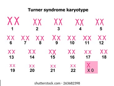 Turner Syndrome Karyotype