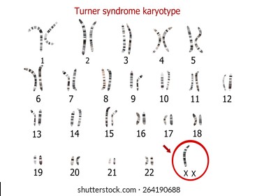 Turner Syndrome Karyotype