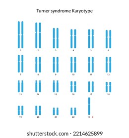 Turner Syndrome (X0) Human Karyotype