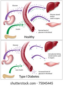 Type 1 Diabetes