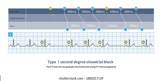 297 Ekg intervals Images, Stock Photos & Vectors | Shutterstock