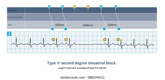 20 Sinoatrial block Images, Stock Photos & Vectors | Shutterstock