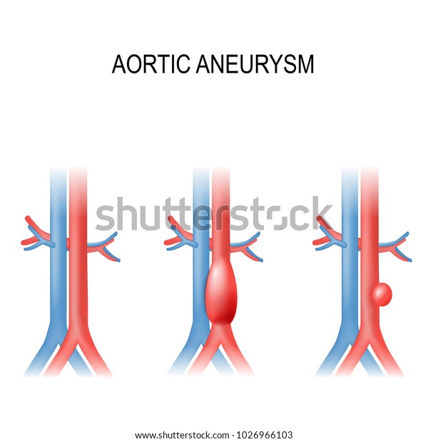 Types Abdominal Aortic Aneurysm Normal Aorta Stock Illustration 1026966103