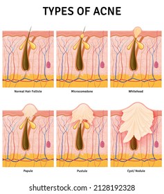 Types Of Acne, Cystic Acne, Structure Of The Skin. Infographic. Illustration Of Follicle And Pimple, Medicine Anatomy, Papule And Pustule, Stages Of Acne.