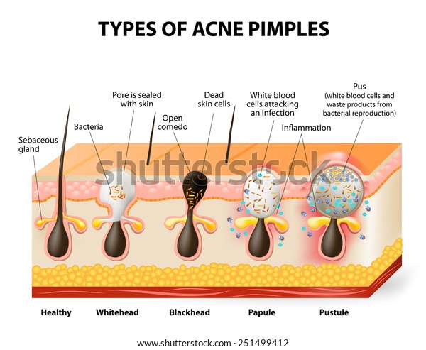 Types of acne pimples. Healthy skin,\
Whiteheads and Blackheads, Papules and\
Pustules