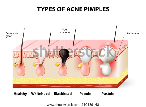 Akne Typen Gesunde Haut Whitehads Und Blackheads Stockillustration