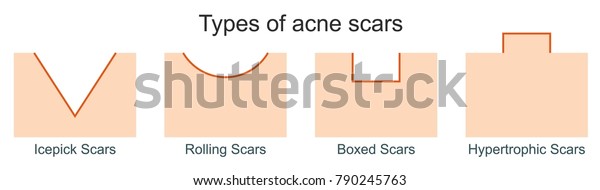 にきびの傷の種類 のイラスト素材