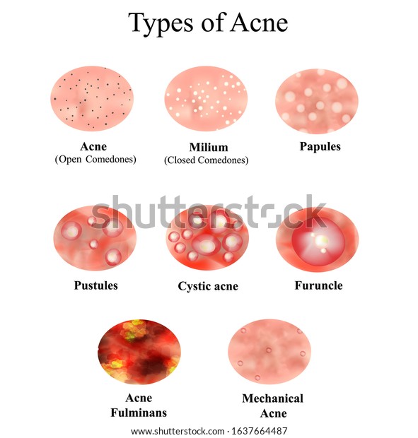 Types Acne Skin Inflammation Pimples Boils Stock Illustration 1637664487 Shutterstock 