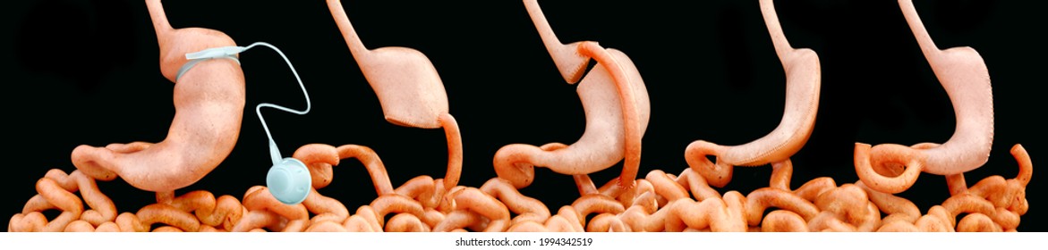 Types Of Bariatric Surgery -- 3D Rendering