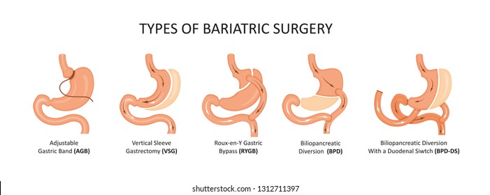 Types Of Bariatric Surgery. Stomach Reduction