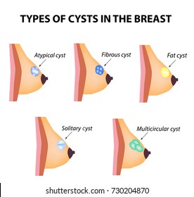 Types Of Cysts In The Breast. Atypical, Fibrous, Fatty Cyst, Solid Cyst, Multicameral. World Breast Cancer Day. Tumor. Illustration On Isolated Background.