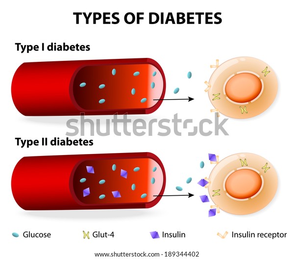 Types Diabetes Type 1 Type 2 Stock-illustration 189344402