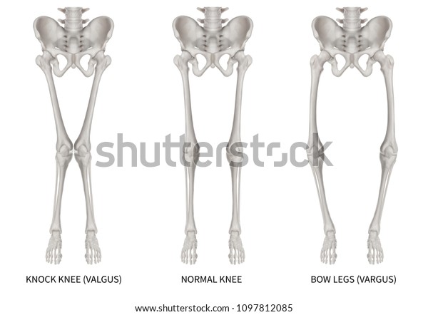 Types Disease Leg Bone Problem Knock Stock Illustration 1097812085