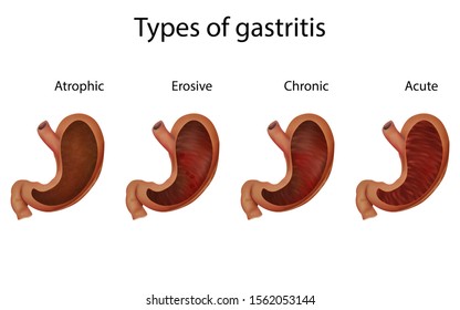 Gastritis Stomach Ulcer Erosion Abdominal Inflammation 스톡 일러스트 ...