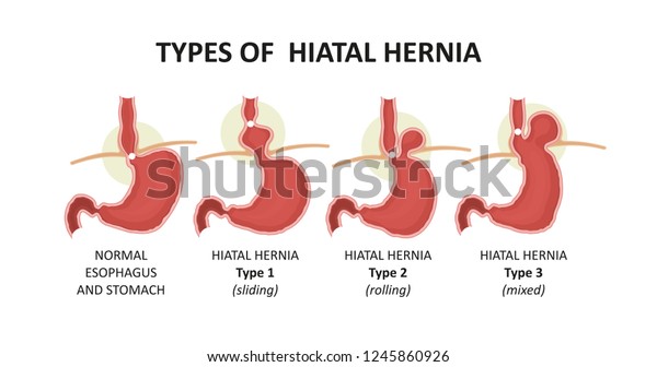 Types Hiatal Hernia Stock Illustration 1245860926