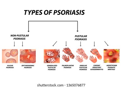 443 Types Psoriasis Images, Stock Photos & Vectors | Shutterstock