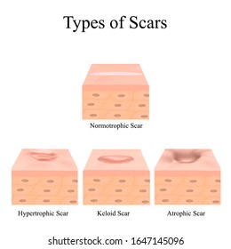 Types of scars. Acne scars. Keloid, hypertrophic, atrophic, normotrophic. The anatomical structure of the skin with acne. illustration on isolated background.