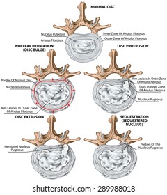Types and stages of lumbar disc herniation, herniated disc, nuclear herniation, disc bulge, protrusion, extrusion, sequestration, lumbar vertebra, intervertebral disk, vertebral bones, superior view