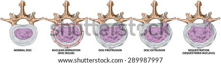 Types and stages of lumbar disc herniation, herniated disc, nuclear herniation, disc bulge, protrusion, extrusion, sequestration, lumbar vertebra, intervertebral disk, vertebral bones, superior view Stock photo © 