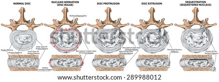 Types and stages of lumbar disc herniation, herniated disc, nuclear herniation, disc bulge, protrusion, extrusion, sequestration, lumbar vertebra, intervertebral disk, vertebral bones, superior view Stock photo © 