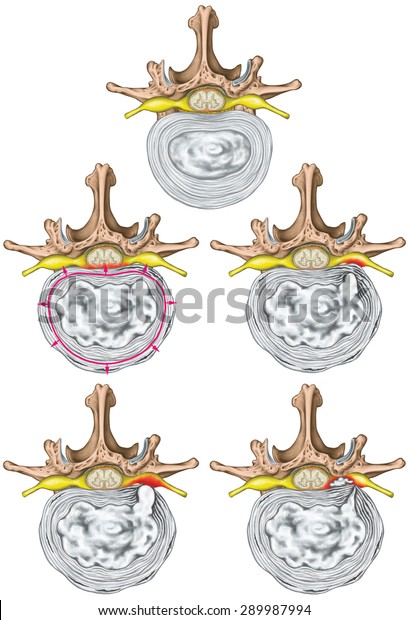 Types Stages Lumbar Disc Herniation Herniated Stock Illustration 289987994