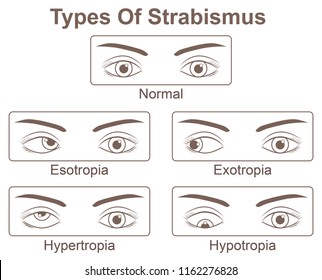 Types Of Strabismus 