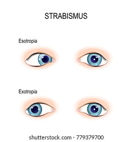 Types Of Strabismus. Crossed Eyes. Esotropia And Exotropia