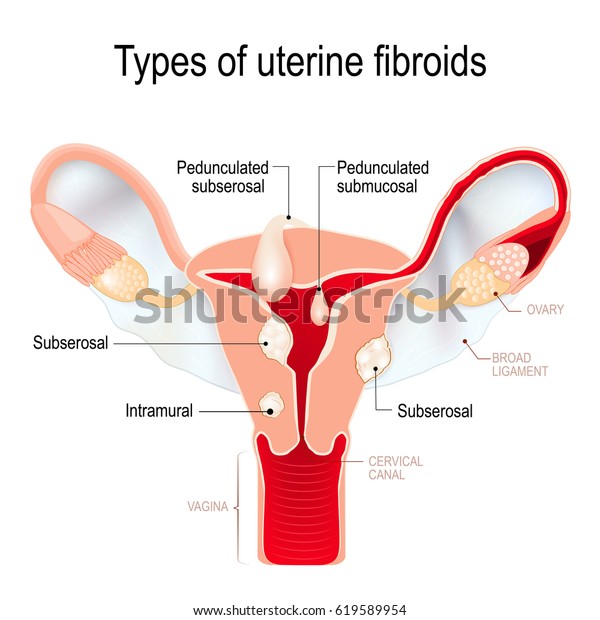 Types Uterine Fibroids Subserosal Intramural Submucosal Stock Illustration 619589954