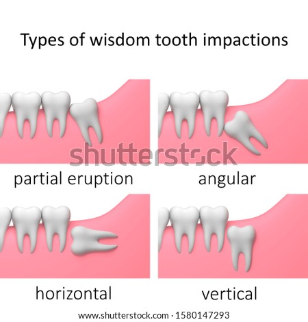 Types of wisdom tooth impactions, white background, collage, 3D-render illustration