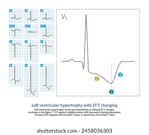 The typical ST-T changing of left ventricular hypertrophy are: ① ST segment slightly convex with downward sloping depression; ②fusion of ST segment and inverted T wave; ③ asymmetry of inverted T wave.