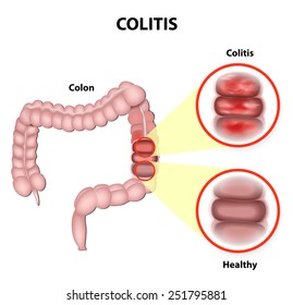 Ulcerative colitis is a chronic disease that results in inflammation of the colon's innermost layer.