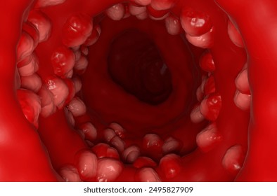 Ulcerative colitis (UC) - section view 3d illustration