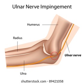 Ulnar Nerve And Cubital Tunnel Syndrome