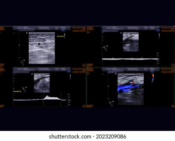 Ultrasound Doppler For Diagnosis   Deep Vein Thrombosis Disease Of Lower Extremity Or DVT.