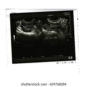 Ultrasound Picture Of Ovaries On White Background. Polycystic Ovary Syndrome (PCOS) Diagnosis. Infertility Problem Concept.