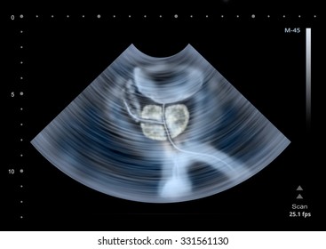 Ultrasound Scan Of Human Prostate. Illustration
