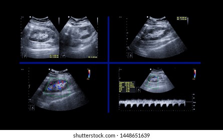 Ultrasound Upper Abdomen Or Ultrasound Kidney Showing Renal Function.