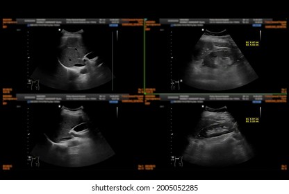 Ultrasound Upper Abdomen Showing  Liver, Gall Bladder And Kidney For Screening Abdominal Disease.