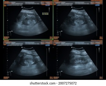 Ultrasound Upper Abdomen Showing  Liver, Gall Bladder And Kidney For Screening Abdominal Disease.