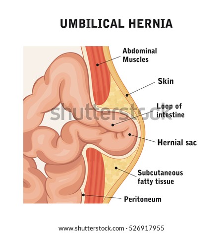 Umbilical Hernia Stock Illustration 526917955 - Shutterstock