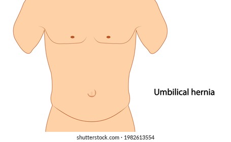 Umilical Hernia Anotomy Illustration. Umbilical Hernia Placement.