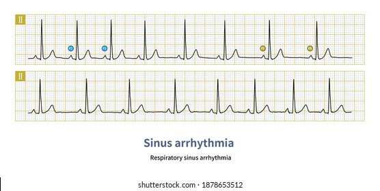 Sinus Arrhythmia Ecg High Res Stock Images Shutterstock