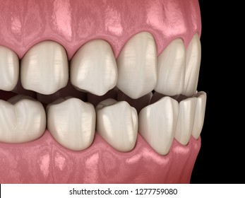 Underbite Dental Occlusion ( Malocclusion Of Teeth ). Medically Accurate Tooth 3D Illustration