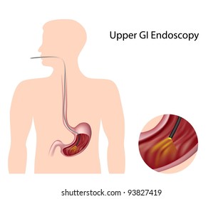 Upper Gastrointestinal Endoscopy