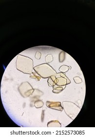 Uric Acid Crystals In A Urine Specimen