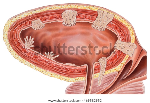 Urinary Bladder Wall Cancer Cancer Urinary 469582952 urinary-bladder-wall-cancer-cancer-urinary-469582952