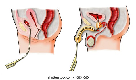 Urinary catheters in situ