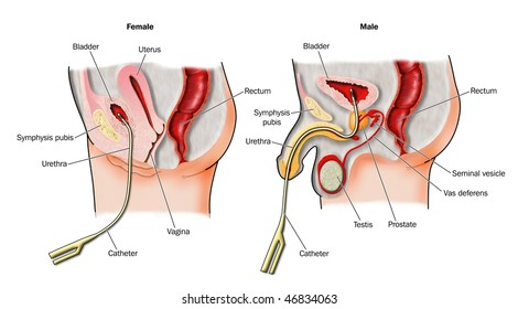 Urinary catheters in situ -- labeled